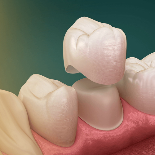 Coroas dentárias