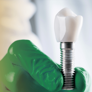Implantes dentários
