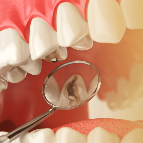 Restaurações dentárias