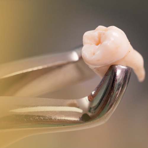 Cirurgias (Extração dentária)