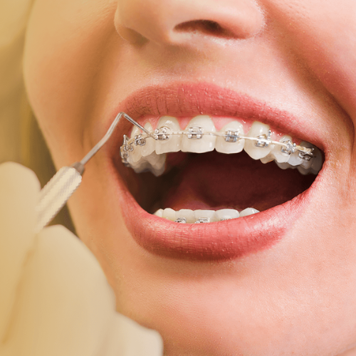 Aparelho ortodôntico